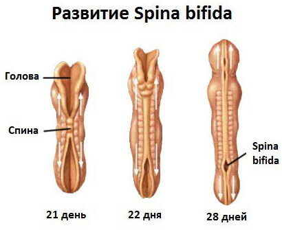 Yetişkinlerde spina bifida S1. Tedavi, ne anlama geliyor?