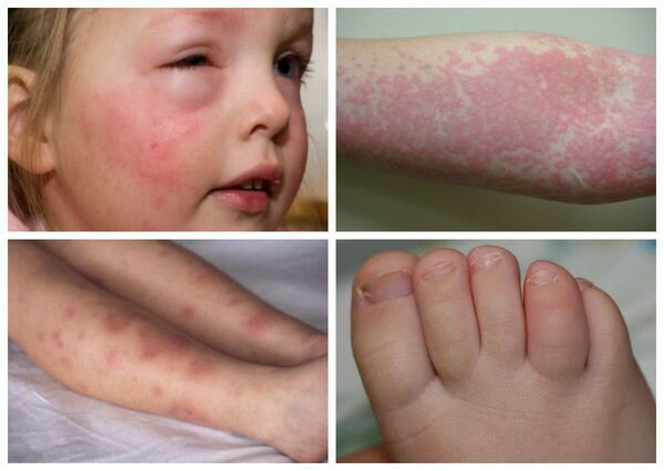 Pseudotuberculosis and yersiniosis. Differential diagnosis