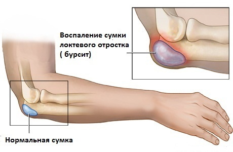Pain in the forearm of the right hand. Reasons and what to do