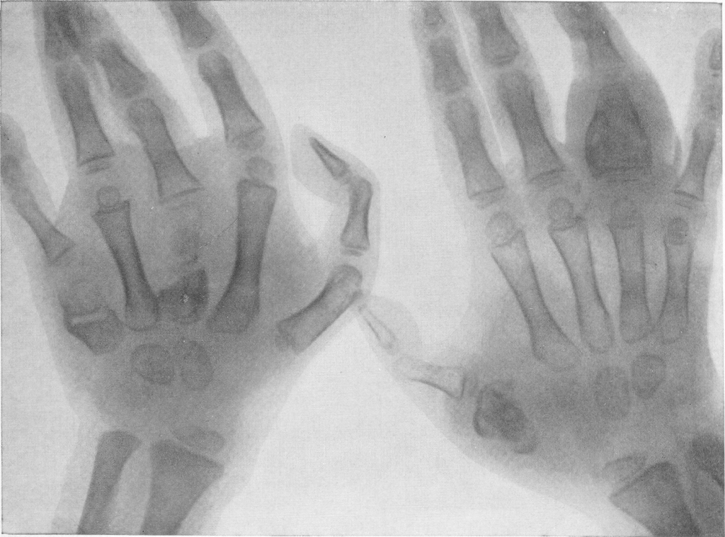 Spina ventosa tuberculosa - multiple lesions of phalanges and metacarpal bones in a child with generalized hematogenous tuberculosis