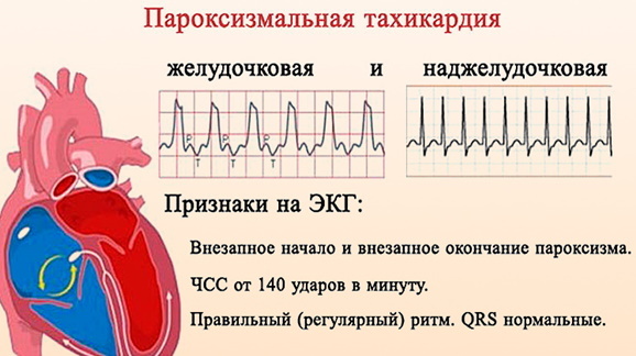 Tachycardia of the heart. Causes, symptoms and treatment
