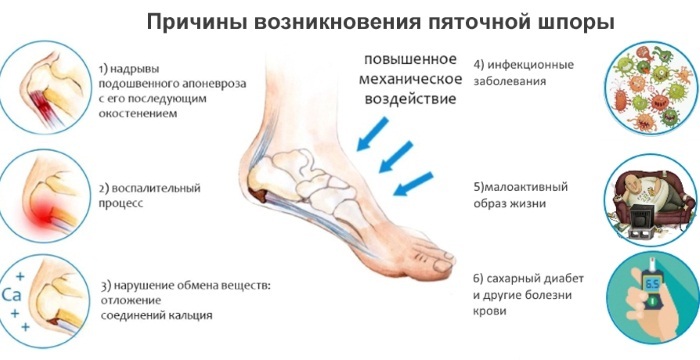 Ontsteking van de zenuw in het been in de voet. Symptomen en behandeling