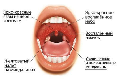 Signos de dolor de garganta