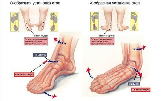 Disease of the leg - the presence of a flat foot resting on the entire sole of the foot, without a recess
