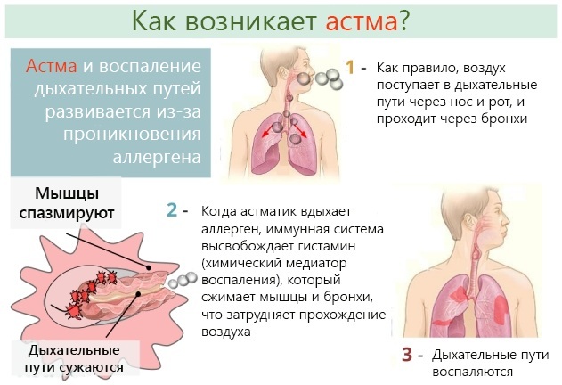 Fizjoterapia astmy oskrzelowej u dorosłych, dzieci