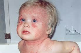Alergia a la piel en los niños: tratamiento, síntomas, foto