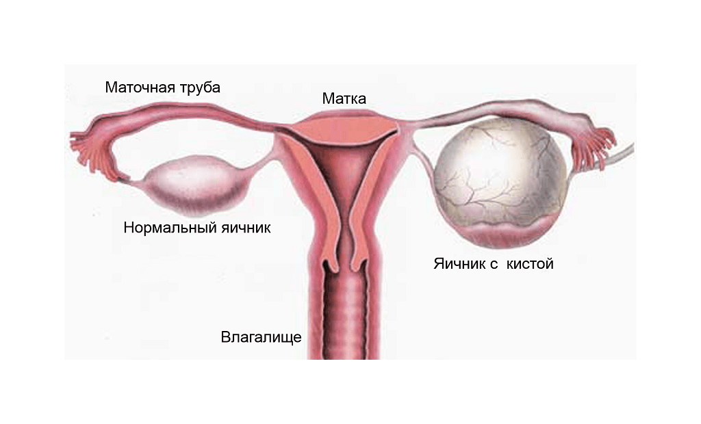 Symptomer på ovariecyster, symptomer - detaljeret information
