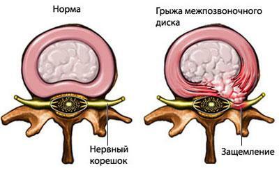 Representación esquemática de un disco intervertebral herniado