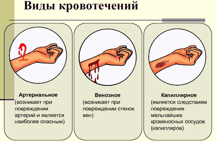 Applying a pressure bandage. Algorithm for the forearm, lower leg, shoulder with venous, arterial bleeding