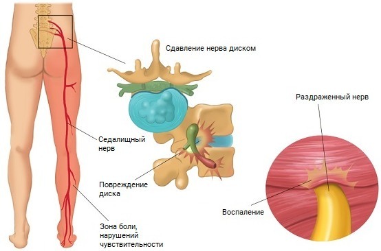 Sidal nerve. Inflammation symptoms, treatment, injections