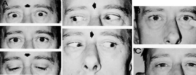 Parino syndrome - why there is paralysis of the vertical eye?