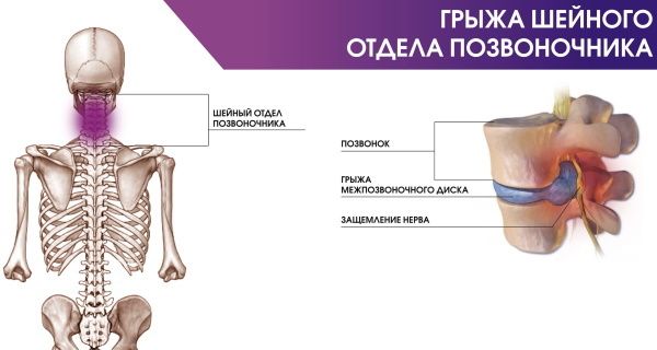 IRM de la gorge et du larynx, du pharynx, de l'œsophage. Ce qui montre le prix à Moscou, Saint-Pétersbourg