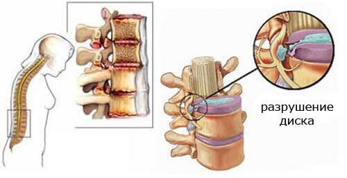 Osteokondrosisli diskin bozulması