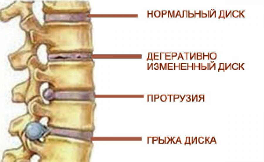 Formación de una hernia