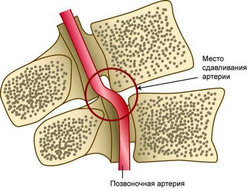 Articulation of the vertebral artery