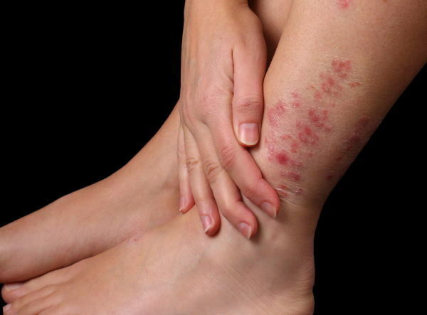 Dermatitis na nogama. Liječenje, masti i kreme za dijete, odraslu osobu