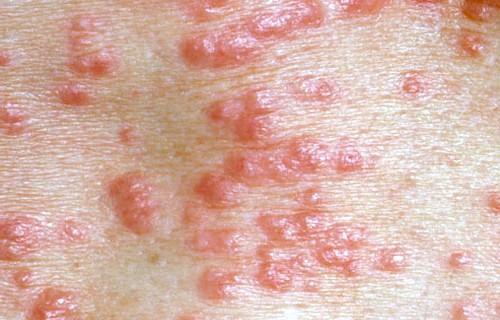 How to recognize and treat scabies