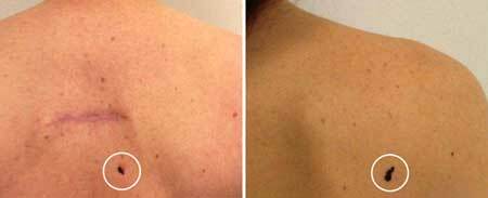 Cancer de piele - fotografii, etapă inițială, simptome și tratament