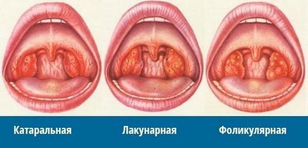 Types of sore throat