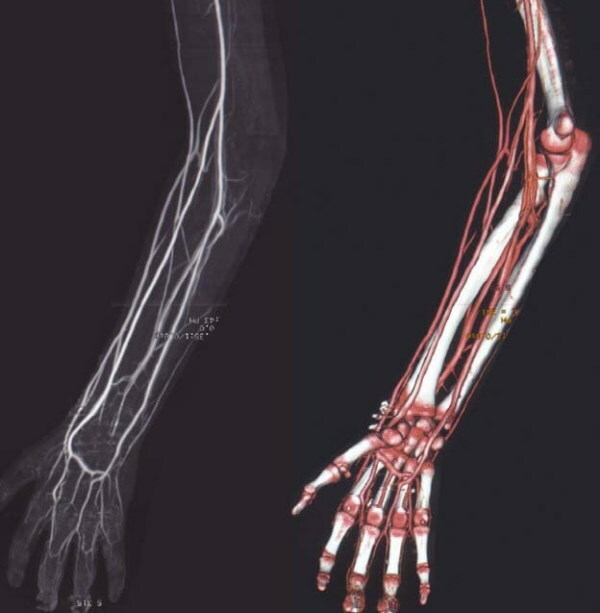 Arterele membrului superior. Anatomie, diagramă, tabel, topografie
