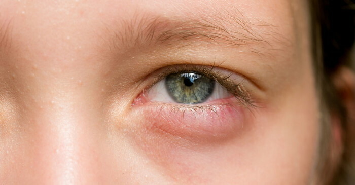 Het onderste ooglid is gezwollen en het oog van het kind doet pijn. Druppels