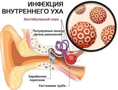 Vestibulär neuronit. Symptom och behandling, träning