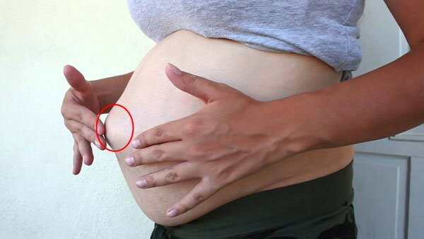 Kliknutia v bruchu počas skorého, neskorého tehotenstva