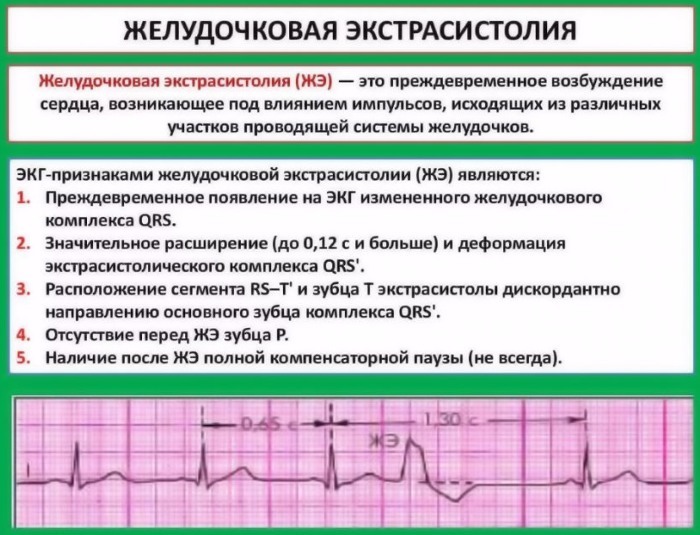 Ventrikularna ekstrasistola na EKG: znaki, kaj je, dekodiranje