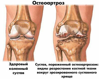 Osteoartritis de la articulación de la rodilla: tratamiento, síntomas, ejercicios, lfq, masajes, tratamiento popular y ungüentos