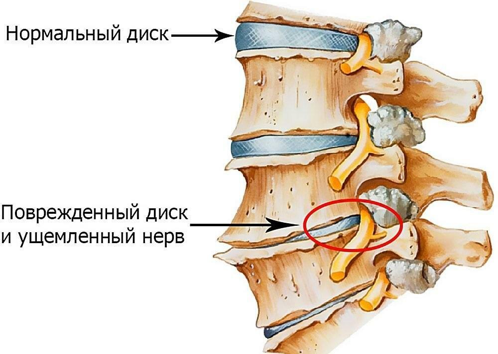 Intervertebral disk with osteochondrosis of the lumbosacral spine