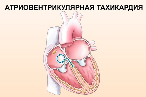 Tachycardia of the heart. Causes, symptoms and treatment
