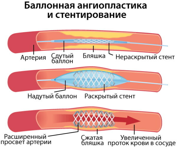 Icke-stenotisk ateroskleros av BCA (brachiocefaliska artärer)