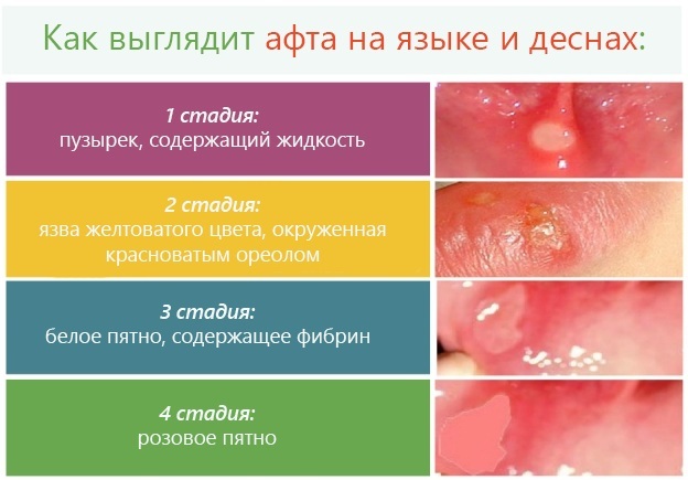 Diş etlerinde stomatit. Merhemler, çocuklar, yetişkinler için tedavi