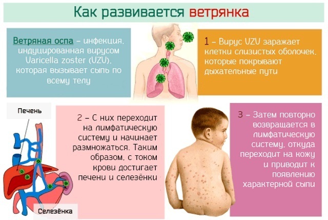 Cum un varicelei la copii, primele semne, simptome și tratament, perioada de incubare