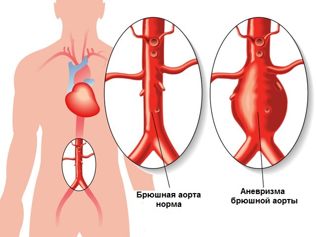 Åreforkalkning af hjertets aorta. Hvad er det, hvad betyder vægtætning?