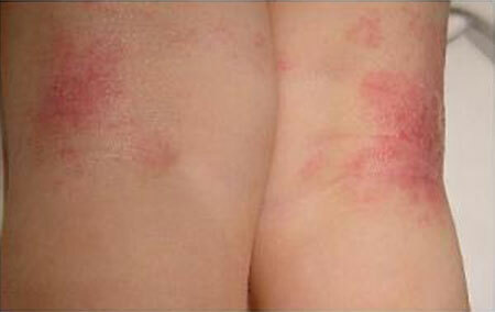 Eczema húmedo: síntomas y tratamiento, foto