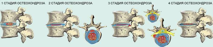Osteokondrosis gelişim derecesinin görsel bir sunumu