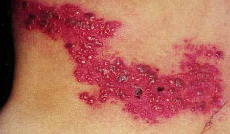 Herpes zoster: fotos, síntomas y tratamiento en adultos