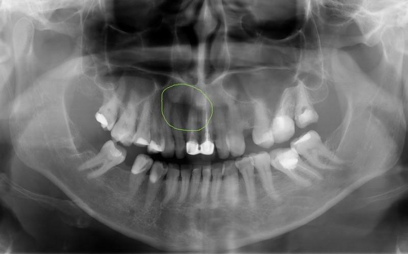 Cyst av tand på röntgen - mer information + foto