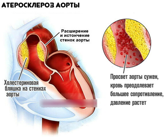 Ateroskleroza srčne aorte. Kaj je to, kaj pomeni tesnjenje sten?