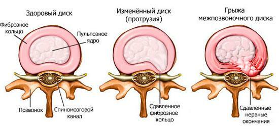 İntervertebral disklerde meydana gelen değişiklikler