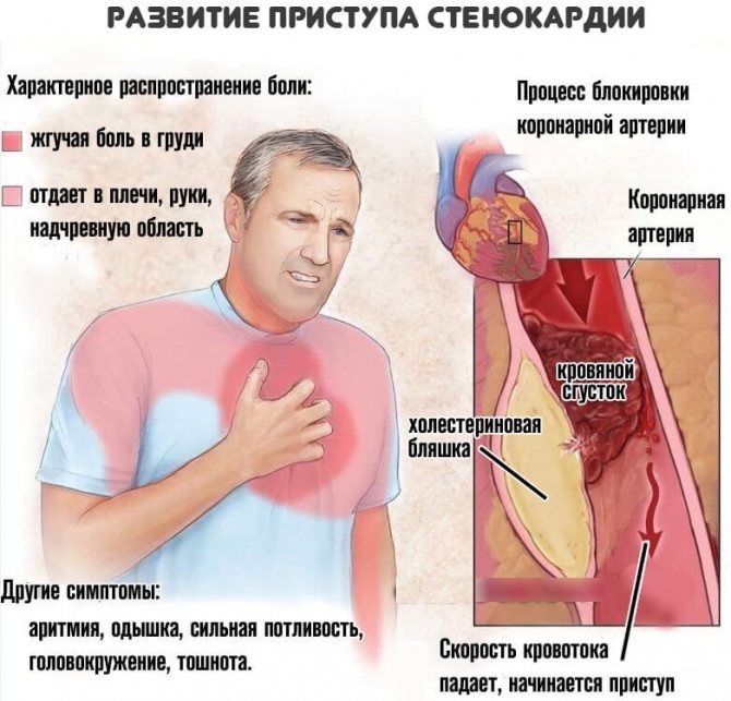 Fark miyokard enfarktüsünün teşhisi. tablo