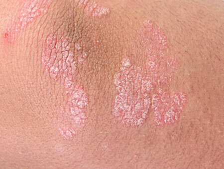 Psoriasis, what is it? First signs and symptoms, stages, treatment