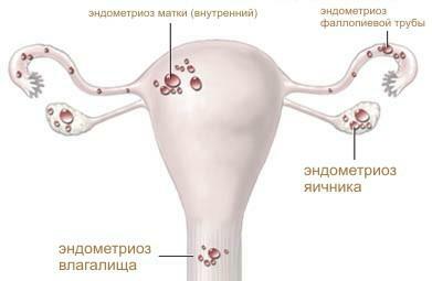 Ubicación de la endometriosis