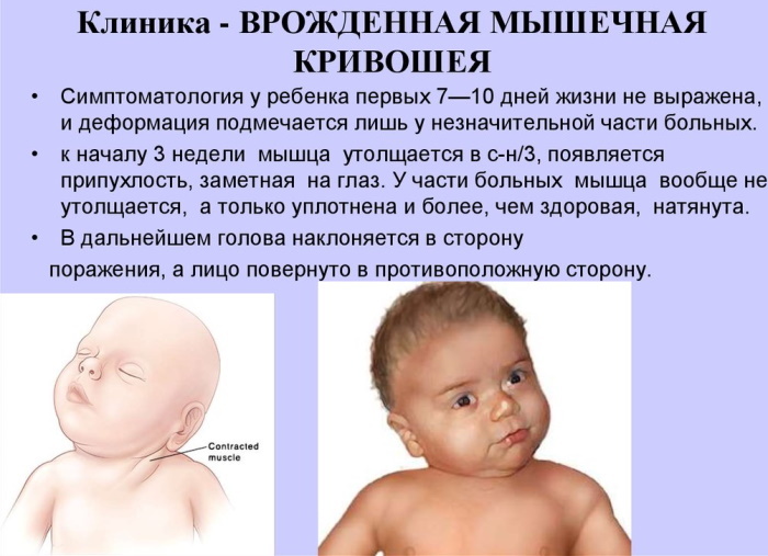 Torcicollo nei neonati 2-3-4-6 mesi. Sintomi, foto, trattamento