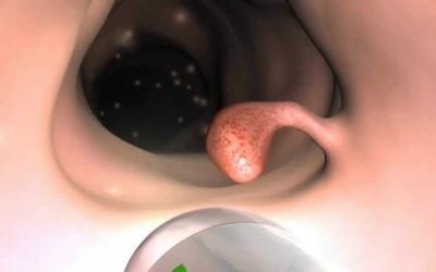 Gastroösophagealer Prolaps der Magenschleimhaut in der Speiseröhre: Was ist das?