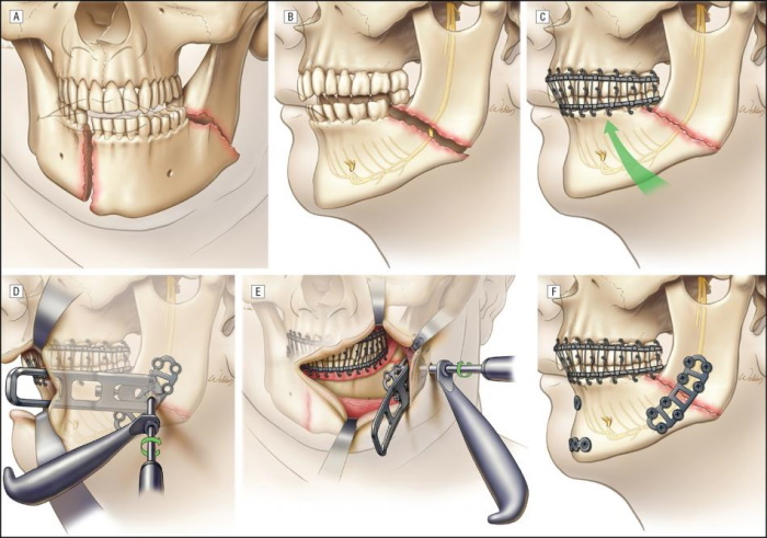 Operație maxilară pentru corectarea mușcăturii. Fotografii înainte și după, recenzii