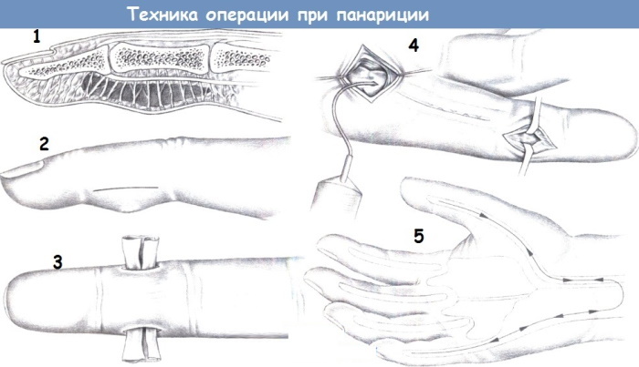 Panaritium del dedo del pie. Síntomas y tratamiento