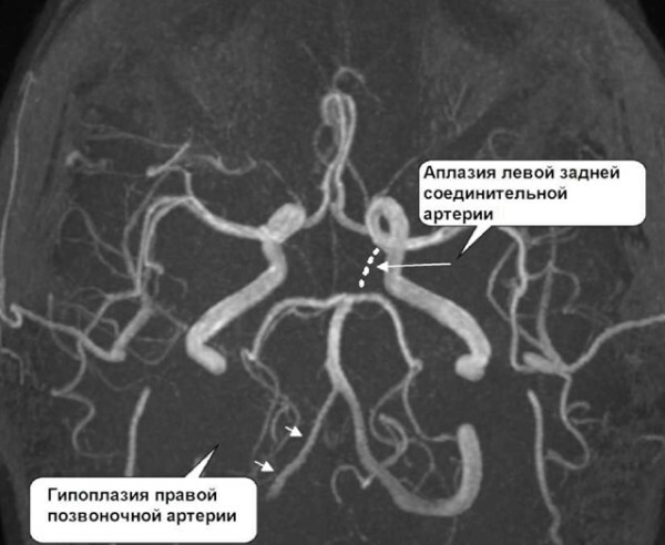 A jobb csigolya artéria hipoplazia. Mi ez, tünetek, kezelés