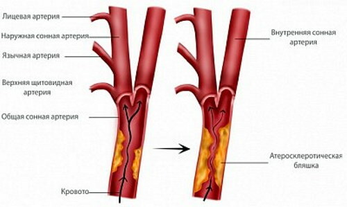 Nestenotická ateroskleróza BCA (brachiocefalické artérie)